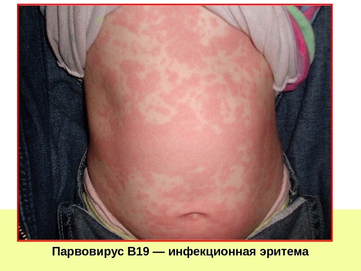   Парвовирус В 19 — инфекционная эритема 