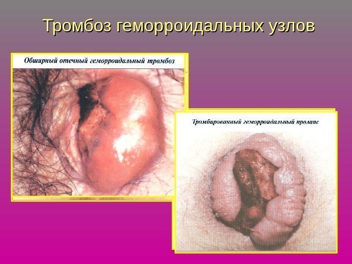   Тромбоз геморроидальных узлов 