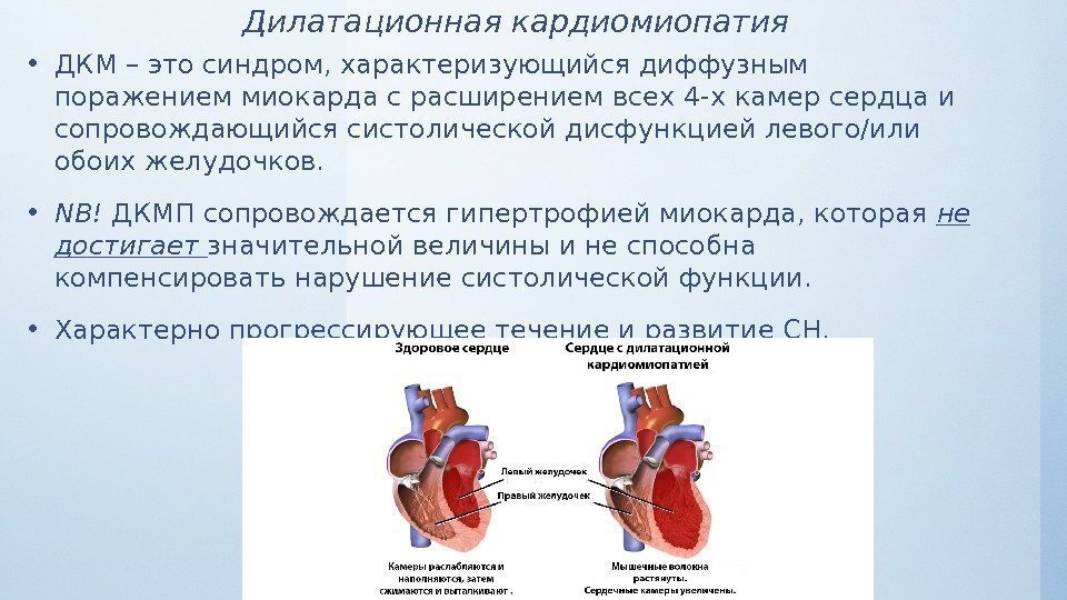 Дилатационная кардиомиопатия • ДКМ – это синдром, характеризующийся диффузным поражением миокарда с расширением всех