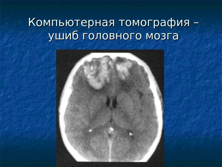  Компьютерная томография – ушиб головного мозга 