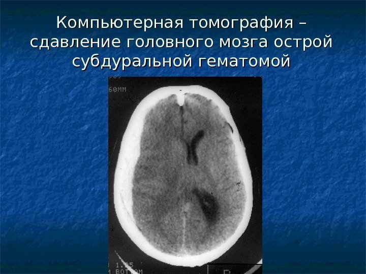  Компьютерная томография – сдавление головного мозга острой субдуральной гематомой 