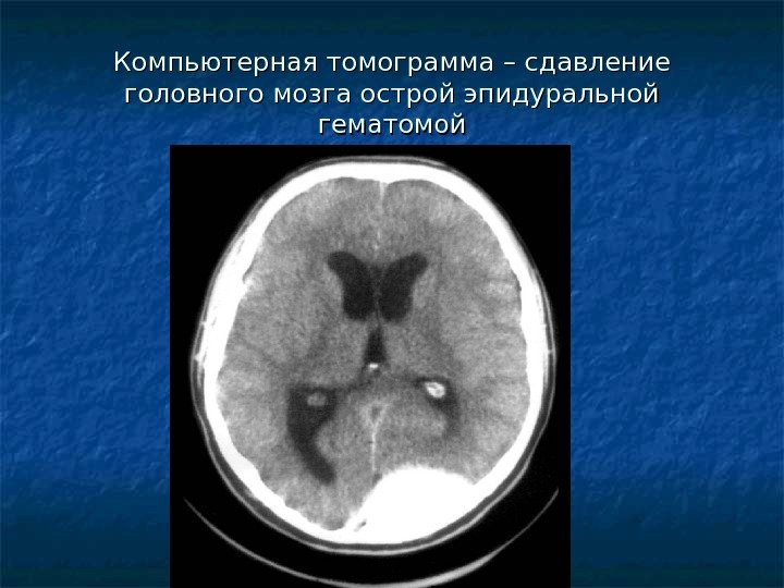   Компьютерная томограмма – сдавление головного мозга острой эпидуральной гематомой 