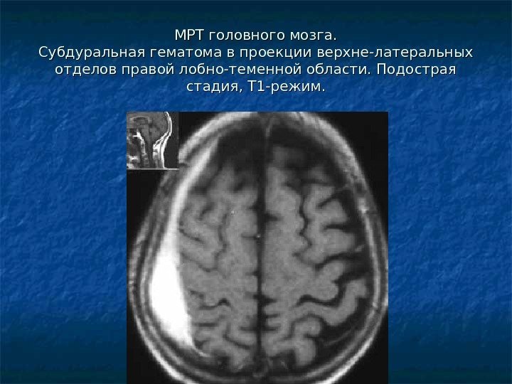  МРТ головного мозга. Субдуральная гематома в проекции верхне-латеральных отделов правой лобно-теменной области.