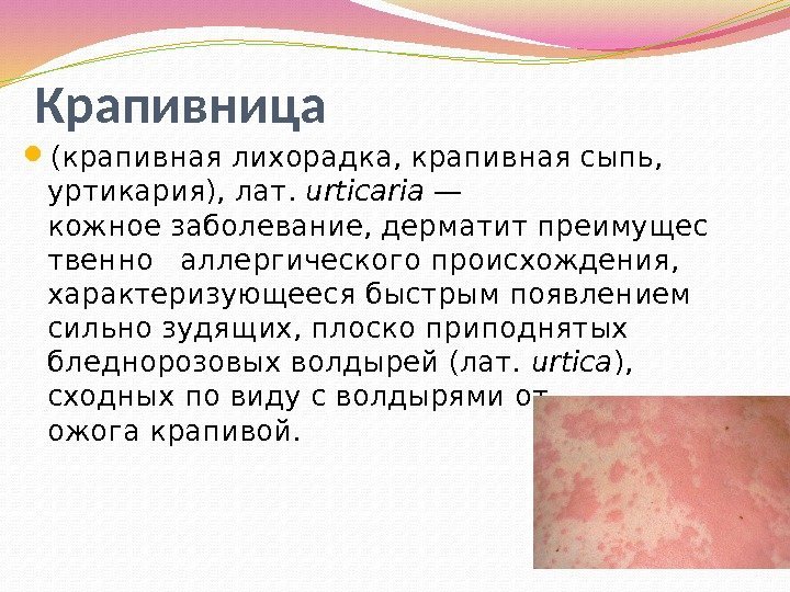 Крапивница  (крапивная лихорадка, крапивная сыпь,  уртикария), лат. urticaria — кожноезаболевание, дерматитпреимущес твенно
