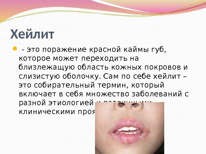 Хейлит  - это поражение красной каймы губ,  которое может переходить на близлежащую