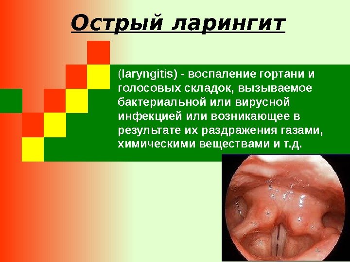 Острый ларингит ( laryngitis) - воспаление гортани и голосовых складок, вызываемое бактериальной или вирусной