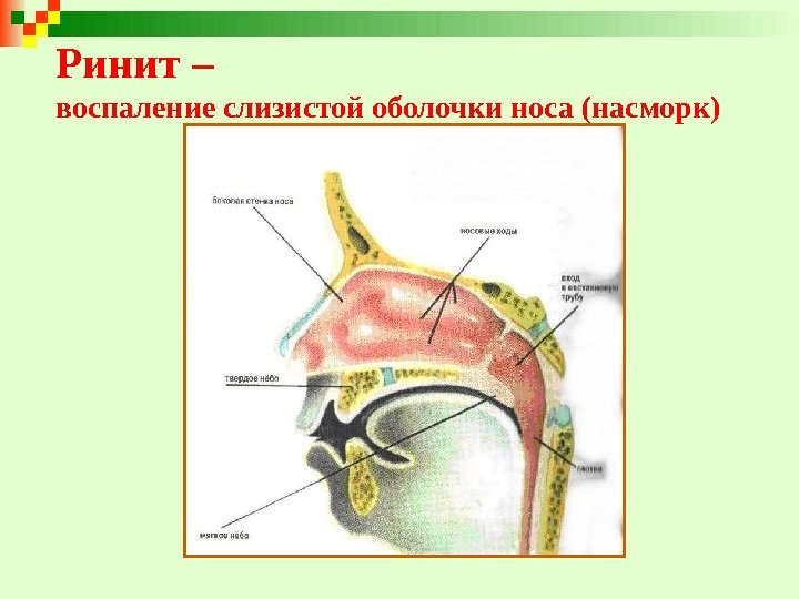 Ринит –  воспаление слизистой оболочки носа (насморк) 