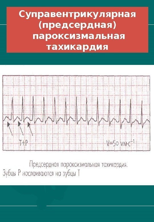   Суправентрикулярная (предсердная)  пароксизмальная тахикардия 