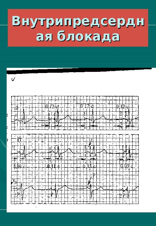   Внутрипредсердн ая блокада 