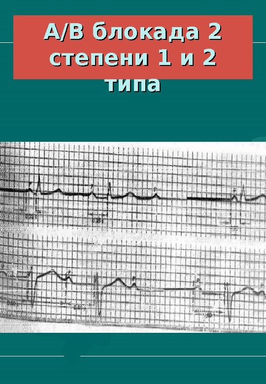   А/В блокада 2 степени 1 и 2 типа 