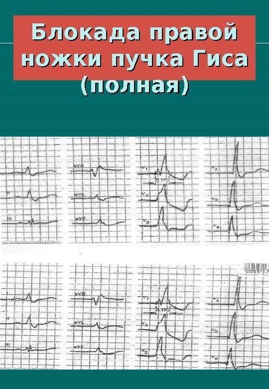   Блокада правой ножки пучка Гиса (полная) 