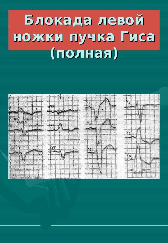   Блокада левой ножки пучка Гиса (полная) 