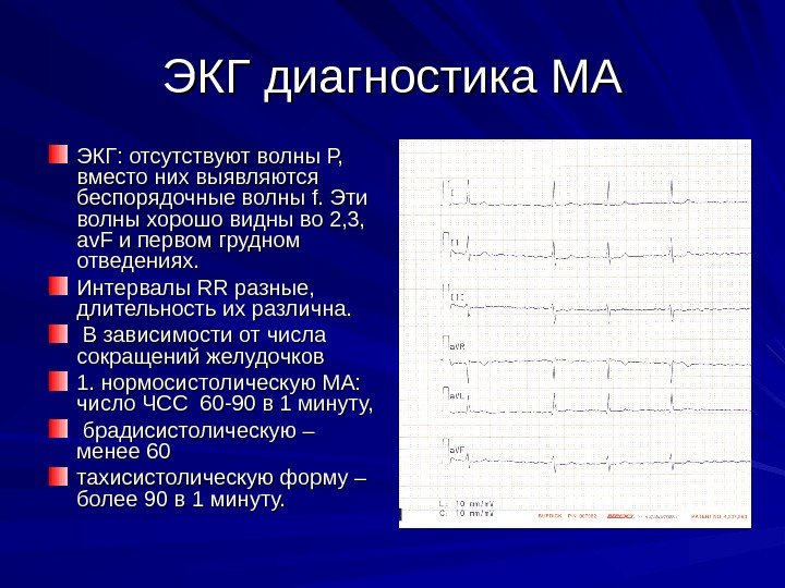 ЭКГ диагностика МА ЭКГ: отсутствуют волны Р,  вместо них выявляются беспорядочные волны ff.