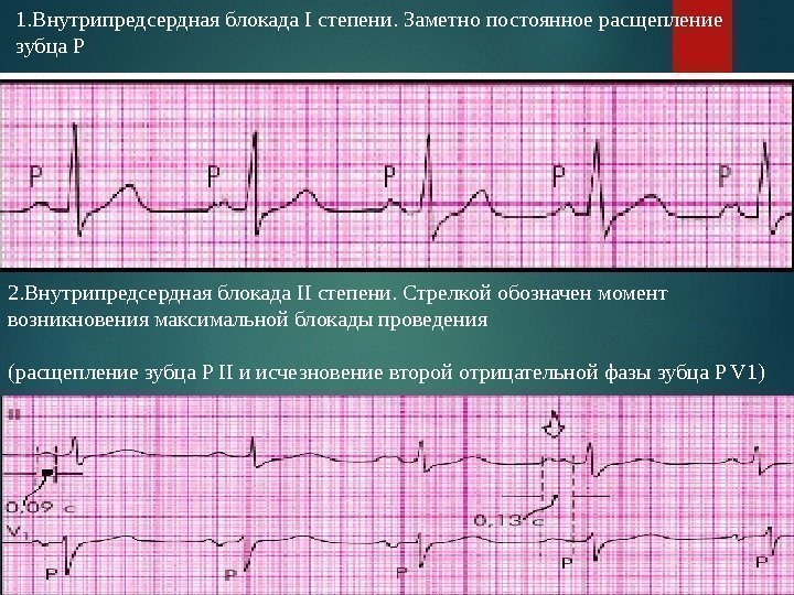 1. Внутрипредсердная блокада I степени. Заметно постоянное расщепление зубца Р 2. Внутрипредсердная блокада II