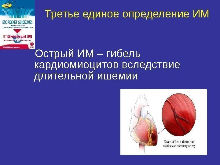 Третье единое определение ИМ Острый ИМ – гибель кардиомиоцитов вследствие длительной ишемии 