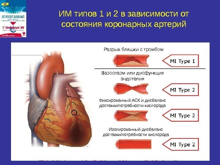 ИМ типов 1 и 2 в зависимости от состояния коронарных артерий Разрыв бляшки с