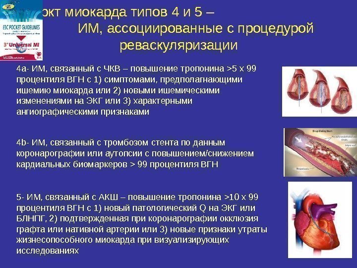 Инфаркт миокарда типов 4 и 5 –    ИМ, ассоциированные с процедурой