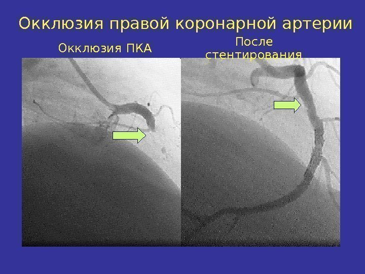 Окклюзия правой коронарной артерии Окклюзия ПКА После стентирования 