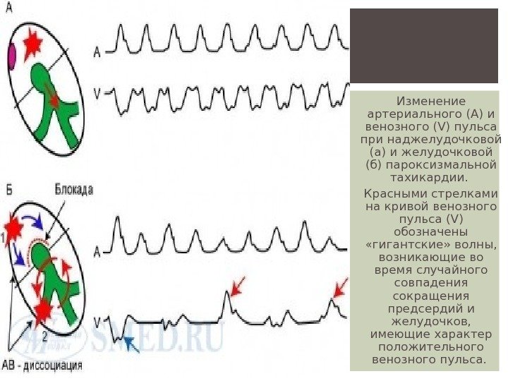 Изменение артериального (А) и венозного (V) пульса при наджелудочковой (а) и желудочковой (б) пароксизмальной