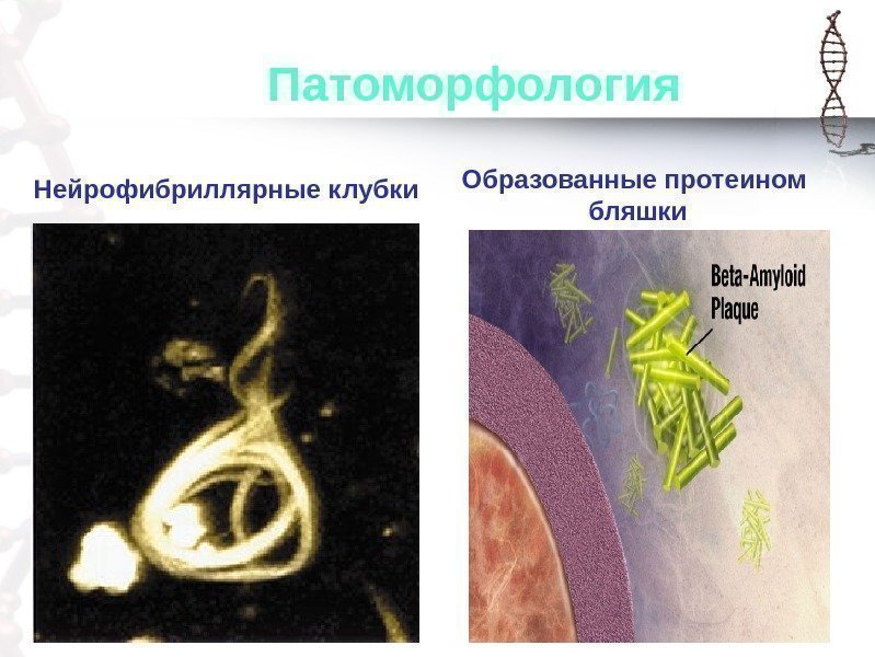    Патоморфология Нейрофибриллярные клубки Образованные протеином  бляшки 
