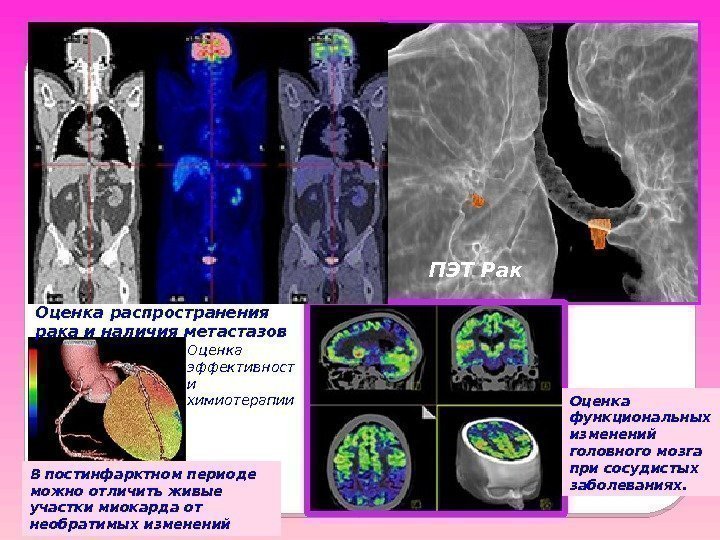 ПЭТ Рак Оценка распространения рака и наличия метастазов В постинфарктном периоде можно отличить живые