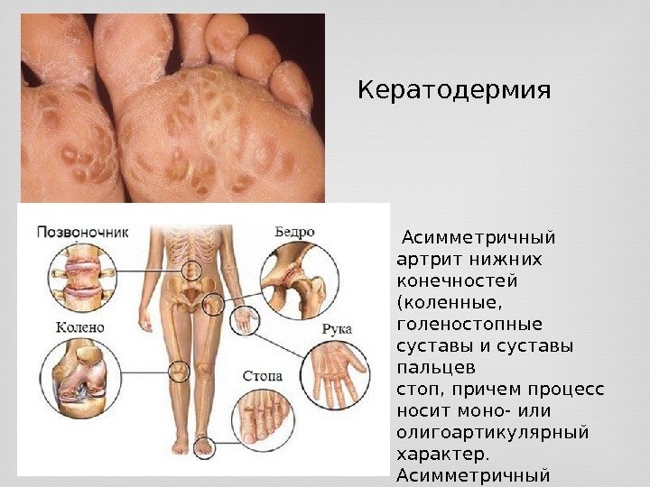 Кератодермия  Асимметричный артрит нижних конечностей (коленные,  голеностопные суставы и суставы пальцев стоп,