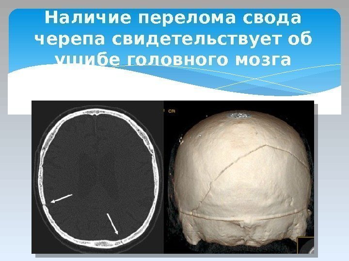 Наличие перелома свода черепа свидетельствует об ушибе головного мозга  