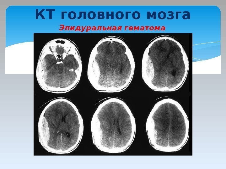 КТ головного мозга Эпидуральная гематома  