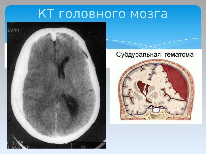 КТ головного мозга  