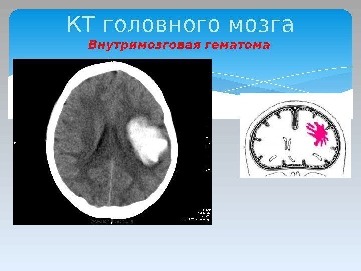 КТ головного мозга Внутримозговая гематома  