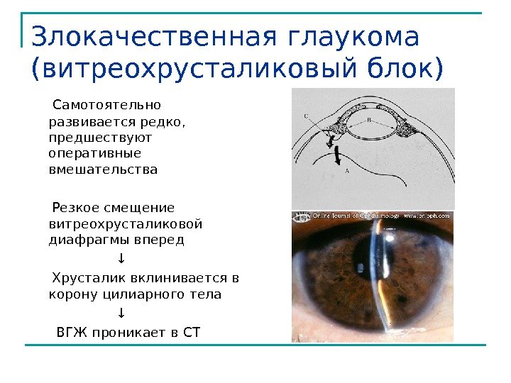 Злокачественная глаукома (витреохрусталиковый блок) Самотоятельно развивается редко,  предшествуют оперативные вмешательства  Резкое смещение
