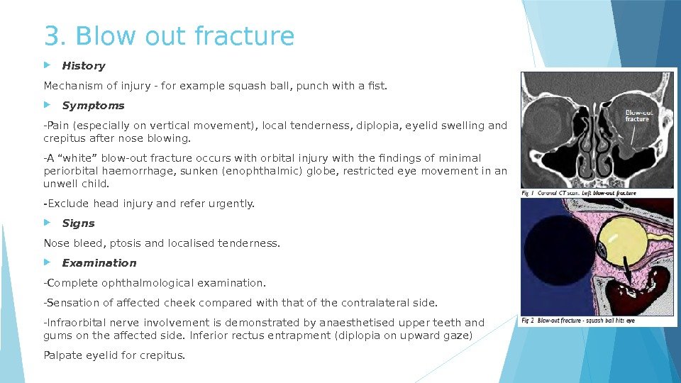 3. Blow out fracture History Mechanism of injury - for example squash ball, punch