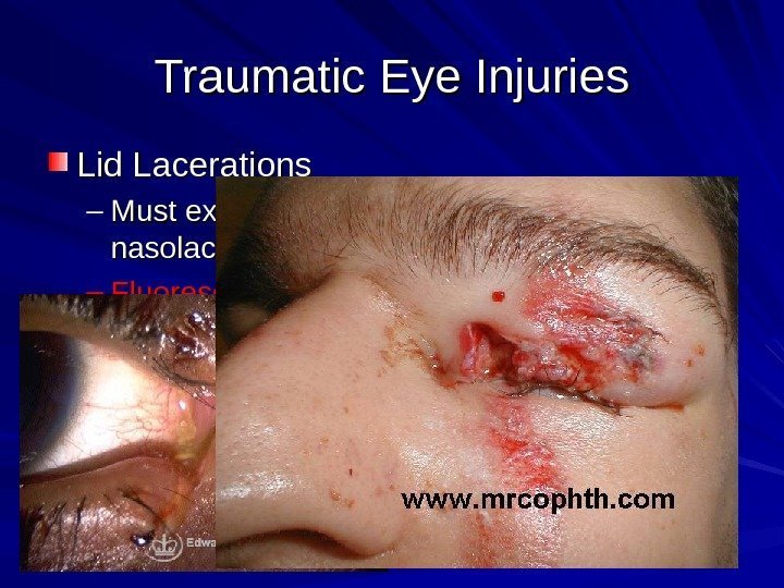 Traumatic Eye Injuries Lid Lacerations – Must exclude damage to eye and nasolacrimal system
