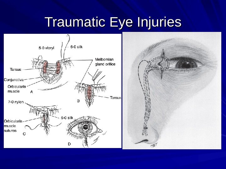 Traumatic Eye Injuries 
