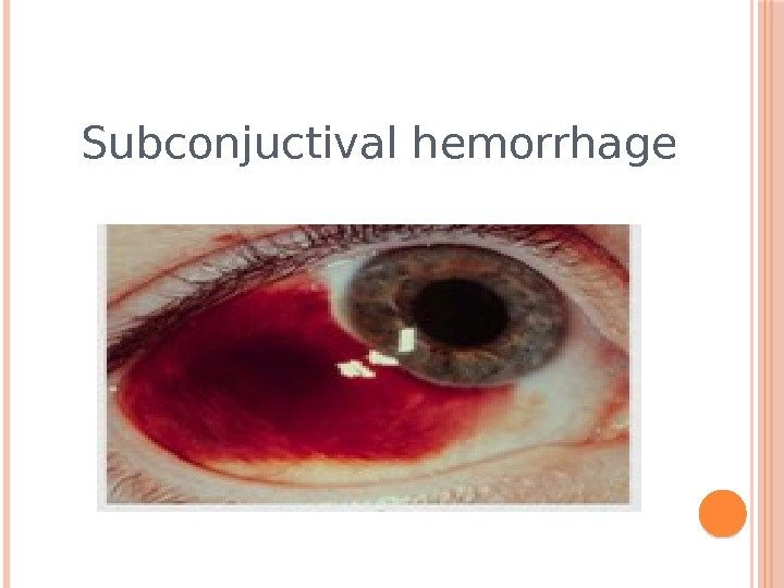 Subconjuctival hemorrhage 