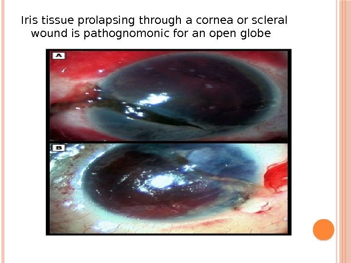 Iris tissue prolapsing through a cornea or scleral wound is pathognomonic for an open