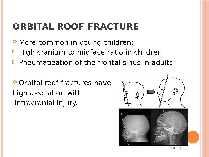 ORBITAL ROOF FRACTURE More common in young children:  High cranium to midface ratio