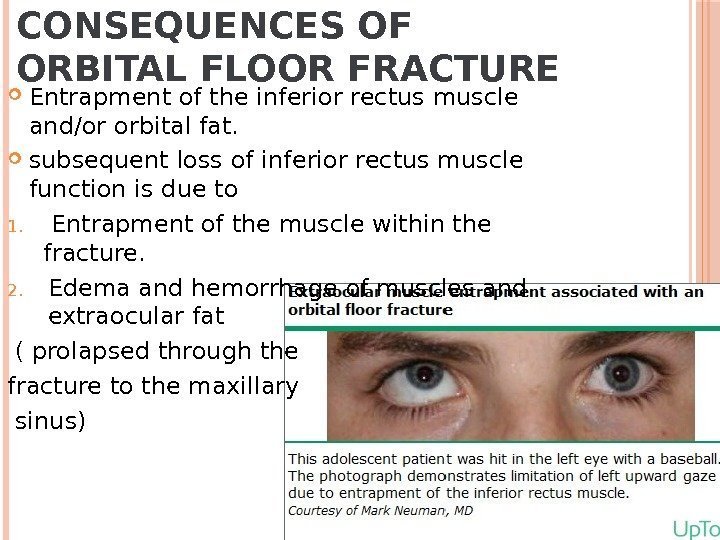 CONSEQUENCES OF ORBITAL FLOOR FRACTURE Entrapment of the inferior rectus muscle and/or orbital fat.