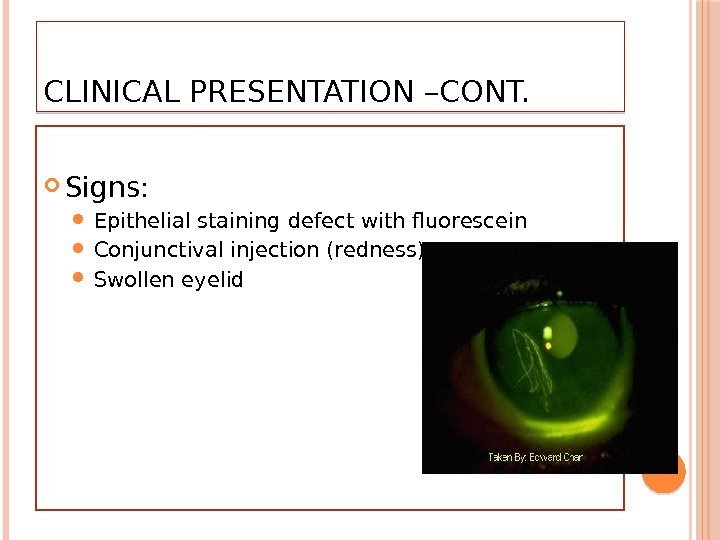 CLINICAL PRESENTATION –CONT.  Signs:  Epithelial staining defect with fluorescein Conjunctival injection (redness)