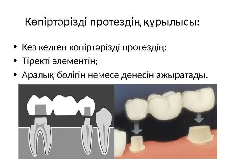 Көпіртәрізді протездің құрылысы:  • Кез келген көпіртәрізді протездің:  • Тіректі элементін; 