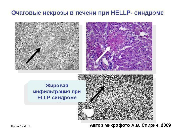 Куликов А. В. Очаговые некрозы в печени при HELLP- синдроме Автор микрофото А. В.