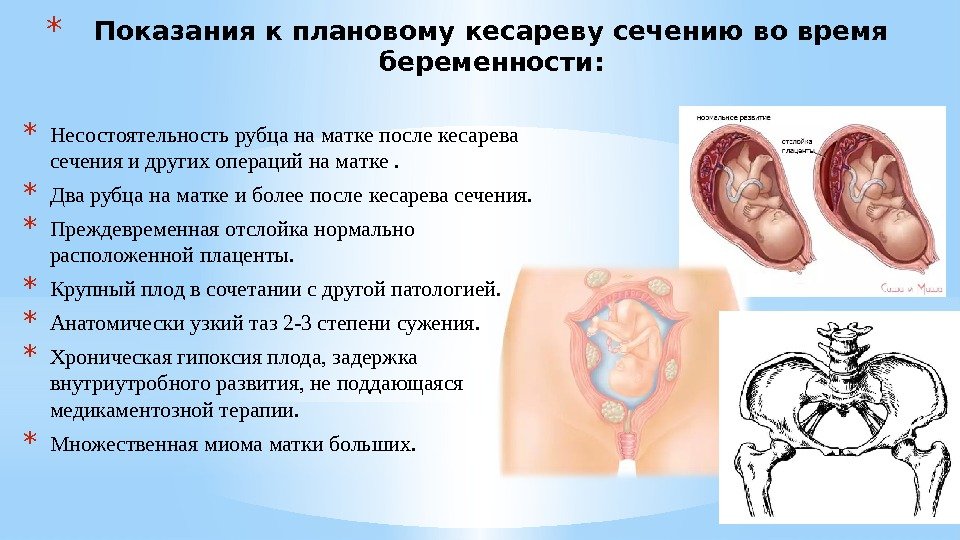 * Показания к плановому кесареву сечению во время беременности: * Несостоятельность рубца на мaтке