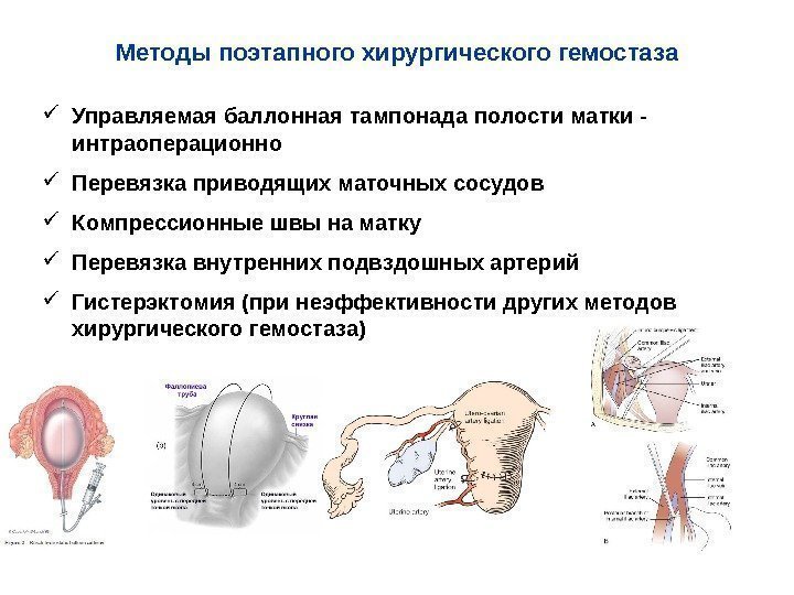 Методы поэтапного хирургического гемостаза Управляемая баллонная тампонада полости матки - интраоперационно Перевязка приводящих маточных