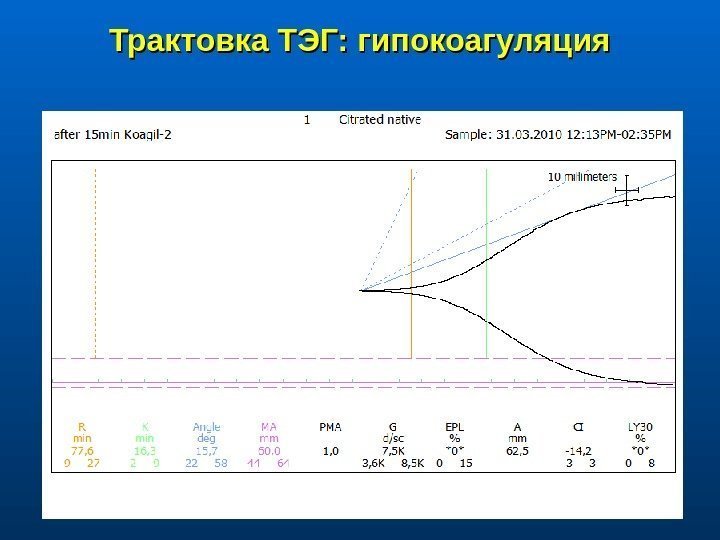 Трактовка ТЭГ: гипокоагуляция 