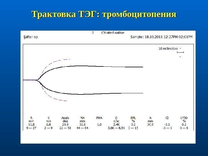 Трактовка ТЭГ: тромбоцитопения 