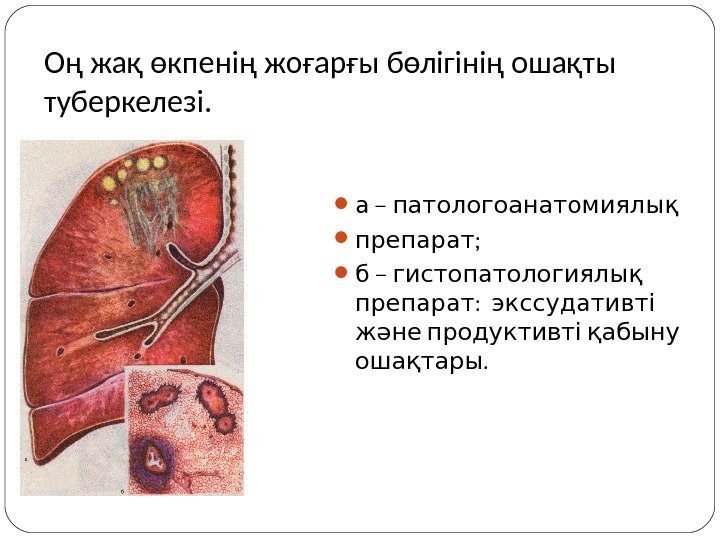 Оң жақ өкпенің жоғарғы бөлігінің ошақты туберкелезі.  – а патологоанатомиялық ;  препарат