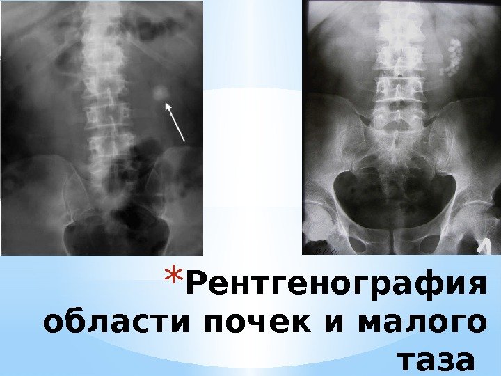 * Рентгенография области почек и малого таза 