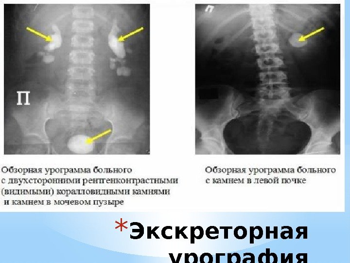 * Экскреторная урография 