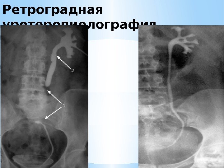 Ретроградная уретеропиелография 