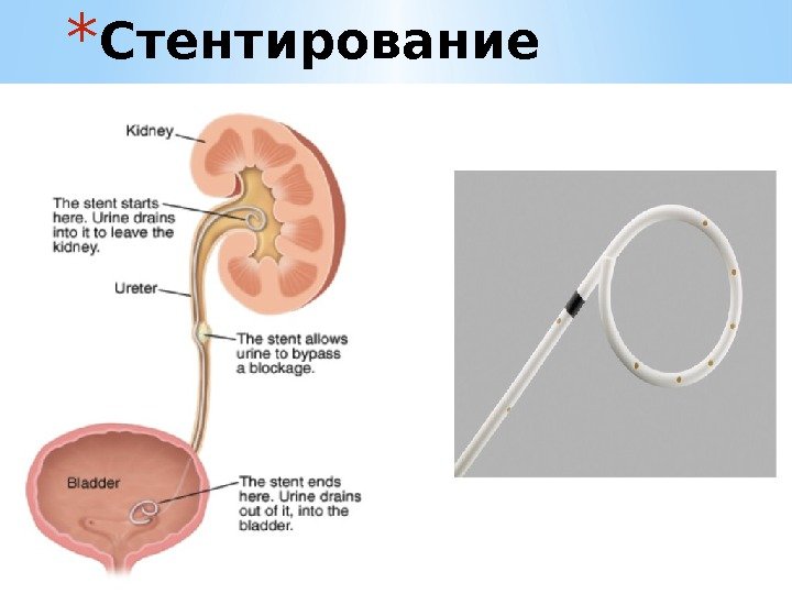 * Стентирование 